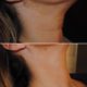 Injections prp cou
