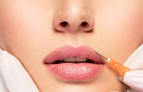 Lip filler Genève